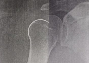 Armazém: agulha é esquecida dentro de paciente pós-cirurgia